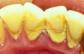 Image result for 大量牙结石