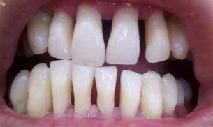 Image result for 牙龈退缩