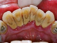 Image result for 牙结石