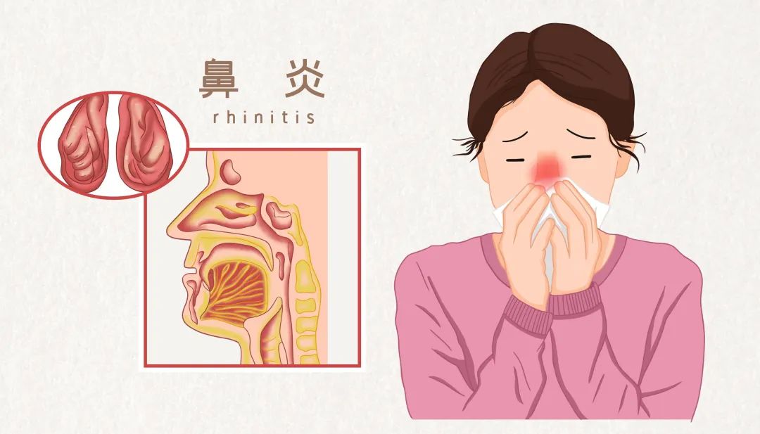 天气变化，鼻炎发作？这些方法可应对