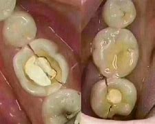 根管治疗后牙齿逐渐变脆 的图像结果