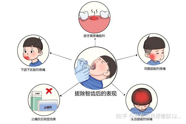 注意！拔牙后出现这些症状，当心是干槽症！ - 知乎