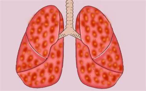 肺部有结节，身体5个表现能看出来，若你有，该养肺了_北京崇文中方中医医院