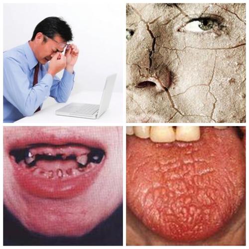 干燥综合症的中药治疗方法是什么