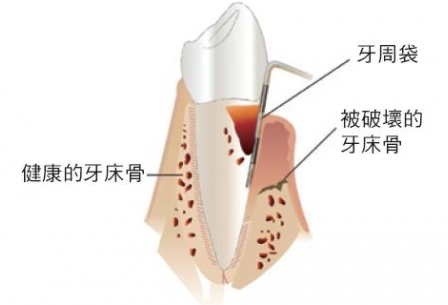 牙周炎 - 牙周治疗-如何治疗牙周炎？-上海治疗牙周炎的价格? - 上海泰康拜博口腔医院
