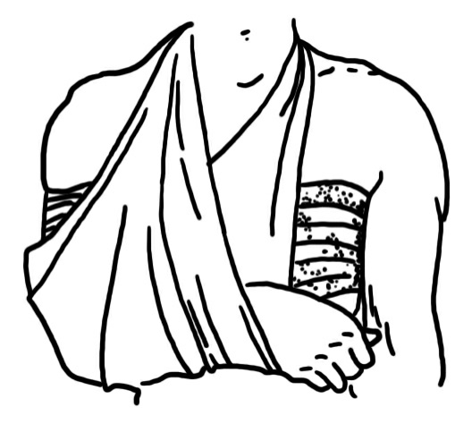 肩关节脱位 - 知乎