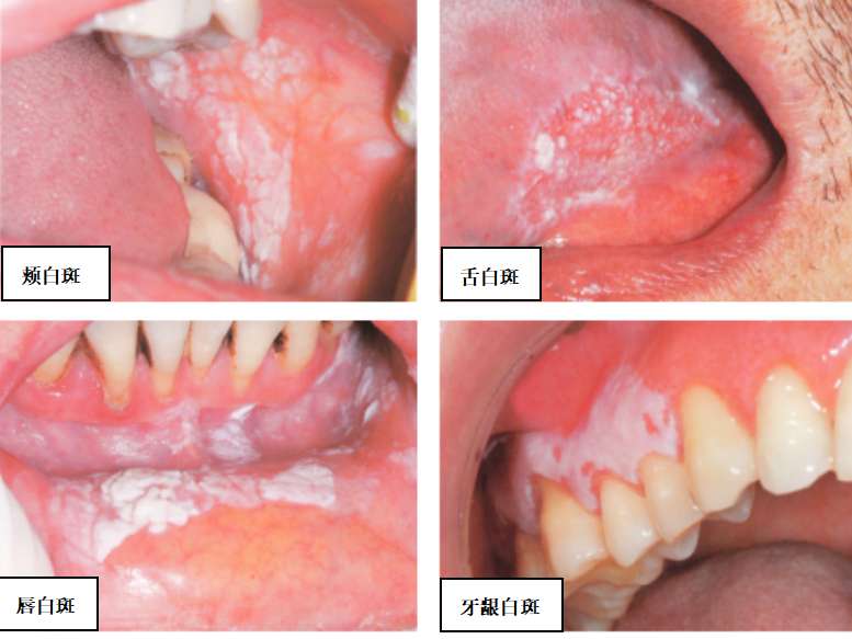 口腔白斑病