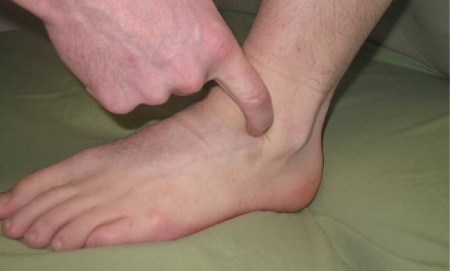 Sinus Tarsi Syndrome - WikiSM (Sports Medicine Wiki)