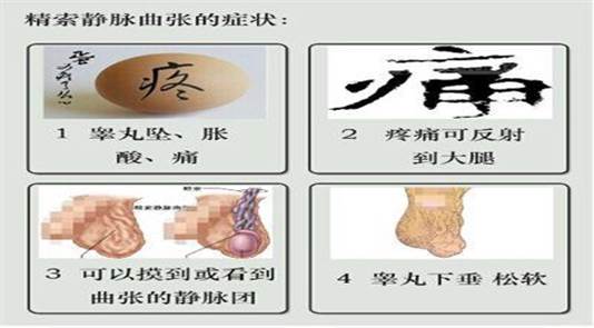 精索静脉曲张2