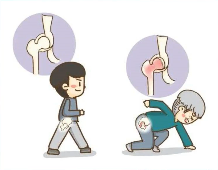 老年髋部骨折_科普文章_健康教育_邹城市人民医院