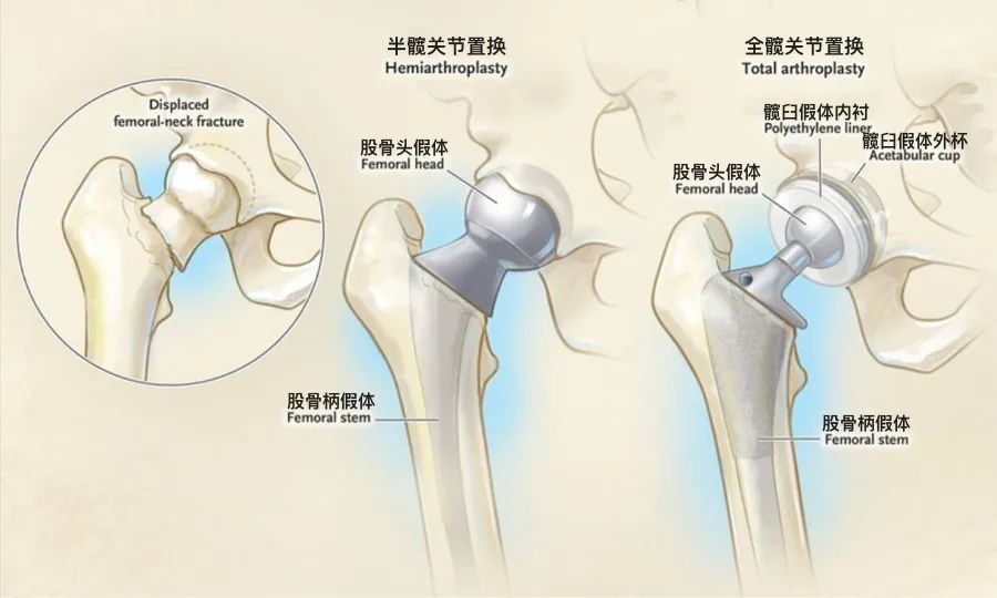 髋关节假体怎么选?越贵越好吗?进口一定强过国产吗? - 北京美德瑞骨科医生集团官方网站