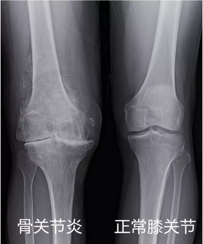骨关节炎的X线读片及治疗,基础必备! - 好医术文章 - 好医术-赋能医生守护生命