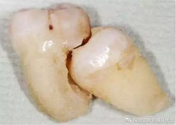 智齿可能导致的问题