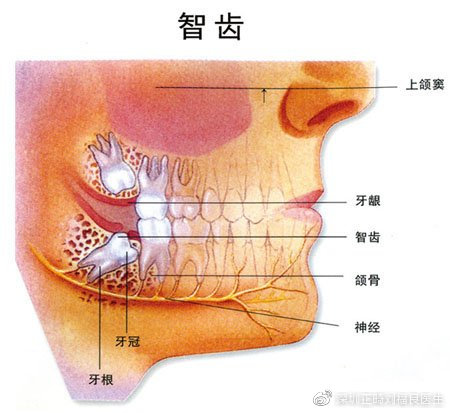 智齿阻生