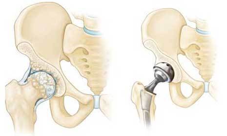 Total Hip Replacement in Indore by Dr. Deepak Mantri | ID: 19345161155