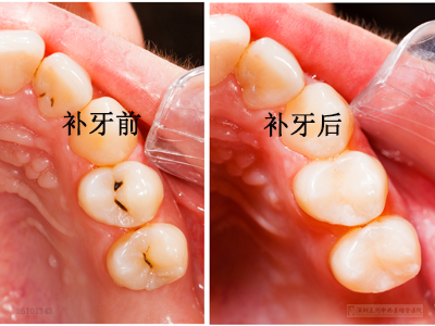 补牙一次搞不定?来回补牙的原因在这里