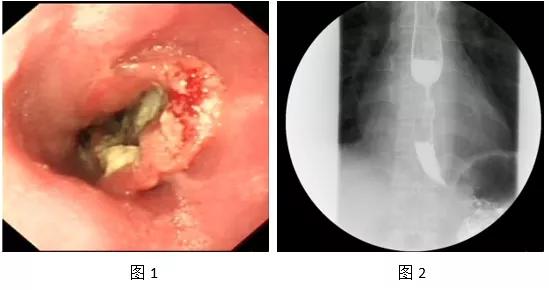 食管癌病人口水多_食管癌病人图片