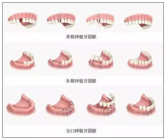 牙齿矫正