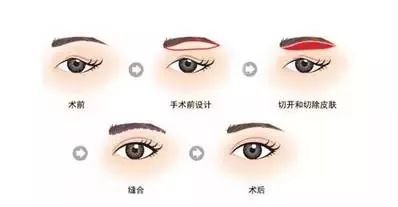 å¡é ä¸å¯¹ç¬¦åç¾å­¦ççæ¯,åæ¶è§£å³ä¸è§ç¼,çé´çº¹ç­é®é¢,è¿ç§ææ¯ç§°æ