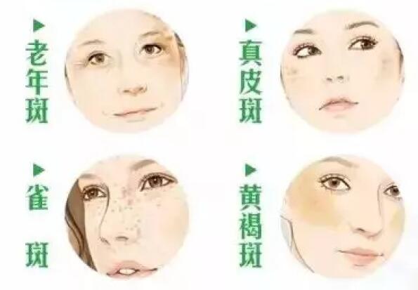 30å²å¥³æ§é¿è²æçåå ,è²æä¼åå¤é¿å å½»åºå»é¤è²æçæ¹æ³