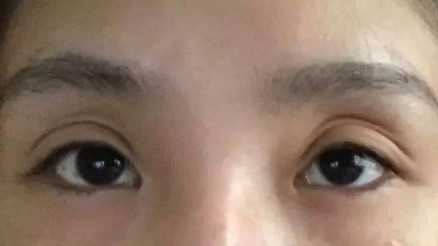 眼窝凹陷示意图