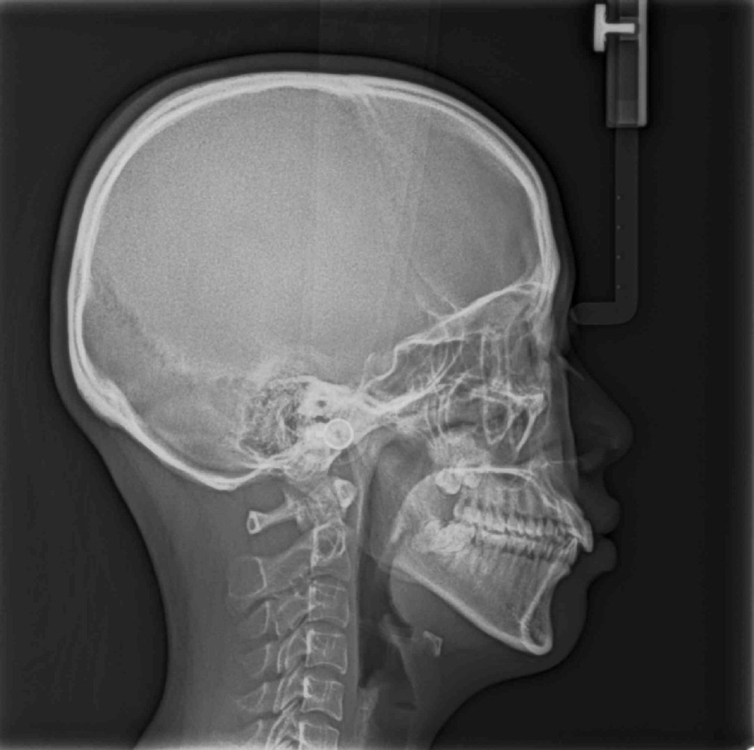 这张侧位片必不可少哦，大家看她是骨性偏多还是牙性偏多呢？