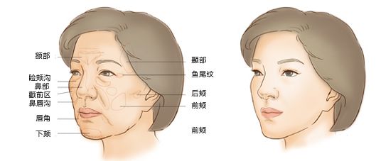 自体脂肪注射填充,好在哪里?