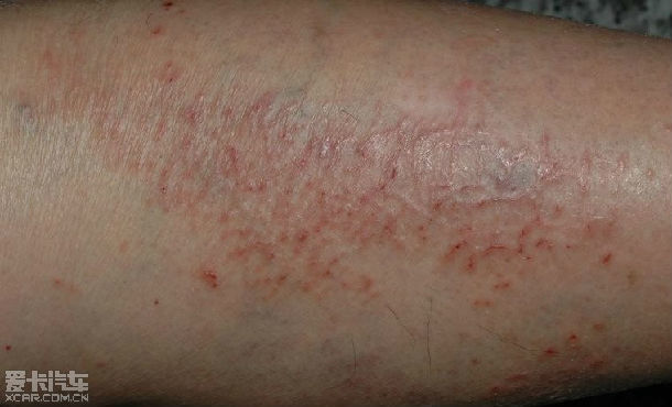 冬季皮炎,又叫乏脂性皮炎,主要是由于冬季气候干燥,皮肤表面油脂分泌