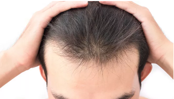 脱发的人都有这10个疑问,答案出乎意料