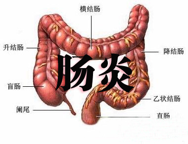 四大理由告訴你,為什麼直腸炎反覆發作?-健康160