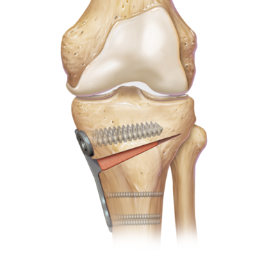 Arthrex - Tibial Opening Wedge