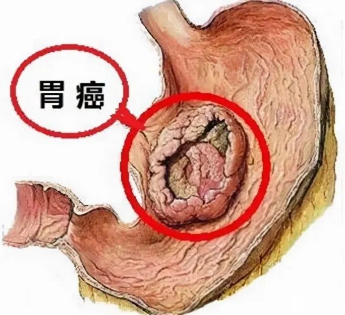 口苦、口臭可能是幽门螺旋杆菌在作怪！医生一文教您杀灭它