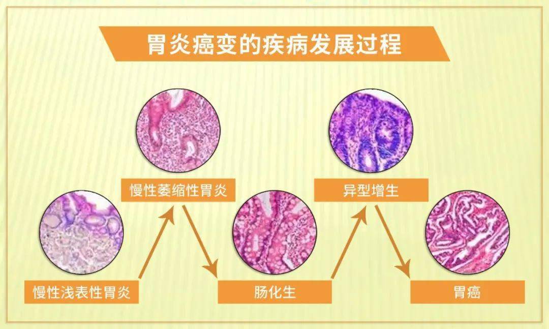 浅表性胃炎-萎缩性胃炎-肠上皮化生-异型增生-早期胃癌-进展期胃癌