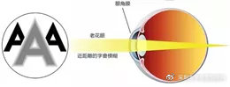 老花眼的成像
