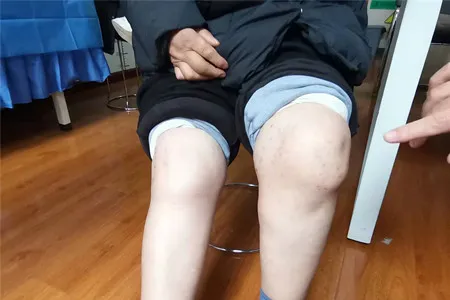 56岁大妈被类风湿疼到哭减轻类风湿患者疼痛需从三点入手