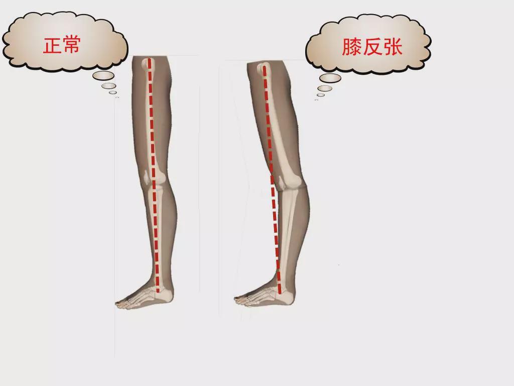 膝反张最佳治疗时间图片