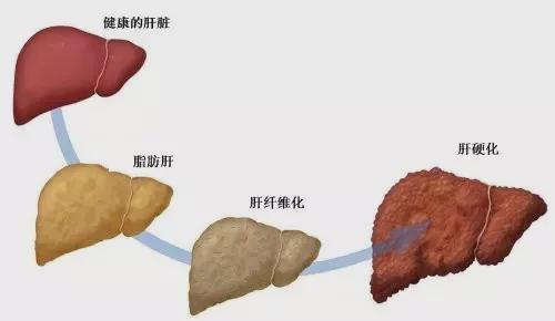 营养科教你一个简单到难以想象的脂肪肝逆转法