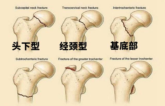 股骨颈<!--HAODF:8:guzhe-->骨折<!--HAODF:/8:guzhe-->以后髋关节总是不适，是不是早期坏死？