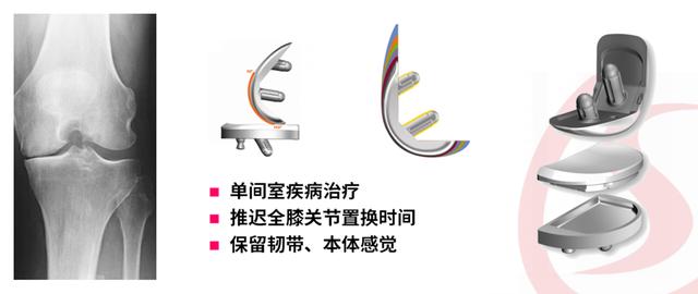 免费的手术机器人联合单髁关节置换手术来了