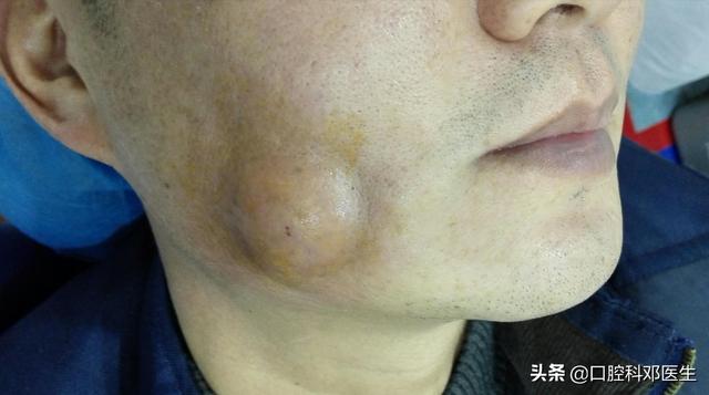 别让一颗牙齿毁了一张脸？医生说95%的人都有这样的牙齿！