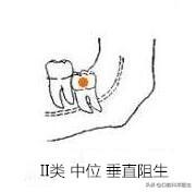 智齿也分三六九等，看看你属于几等？