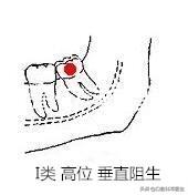 智齿也分三六九等，看看你属于几等？