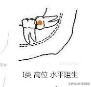 智齿也分三六九等，看看你属于几等？