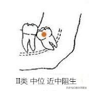 智齿也分三六九等，看看你属于几等？