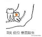 智齿也分三六九等，看看你属于几等？