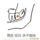 智齿也分三六九等，看看你属于几等？