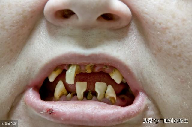 医生总结的拔牙要诀：8拔9不拔，无齿之徒可忽视！