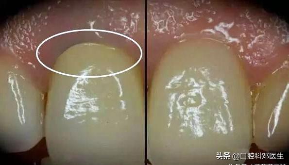 牙医为什么总向你推荐全瓷牙？我这有答案！