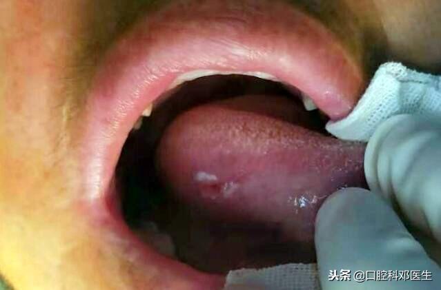 90%的人易忽视的4种口腔溃疡，看看专家怎么说？