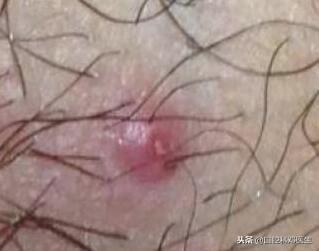 90%的人易忽视的4种口腔溃疡，看看专家怎么说？
